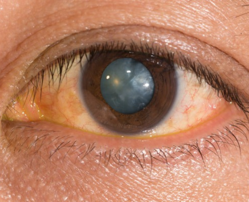 Understanding Cataracts